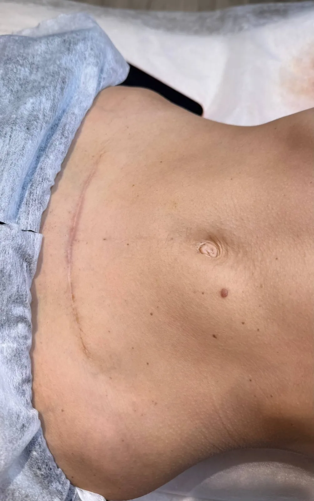 Healed C-section scar at consultation