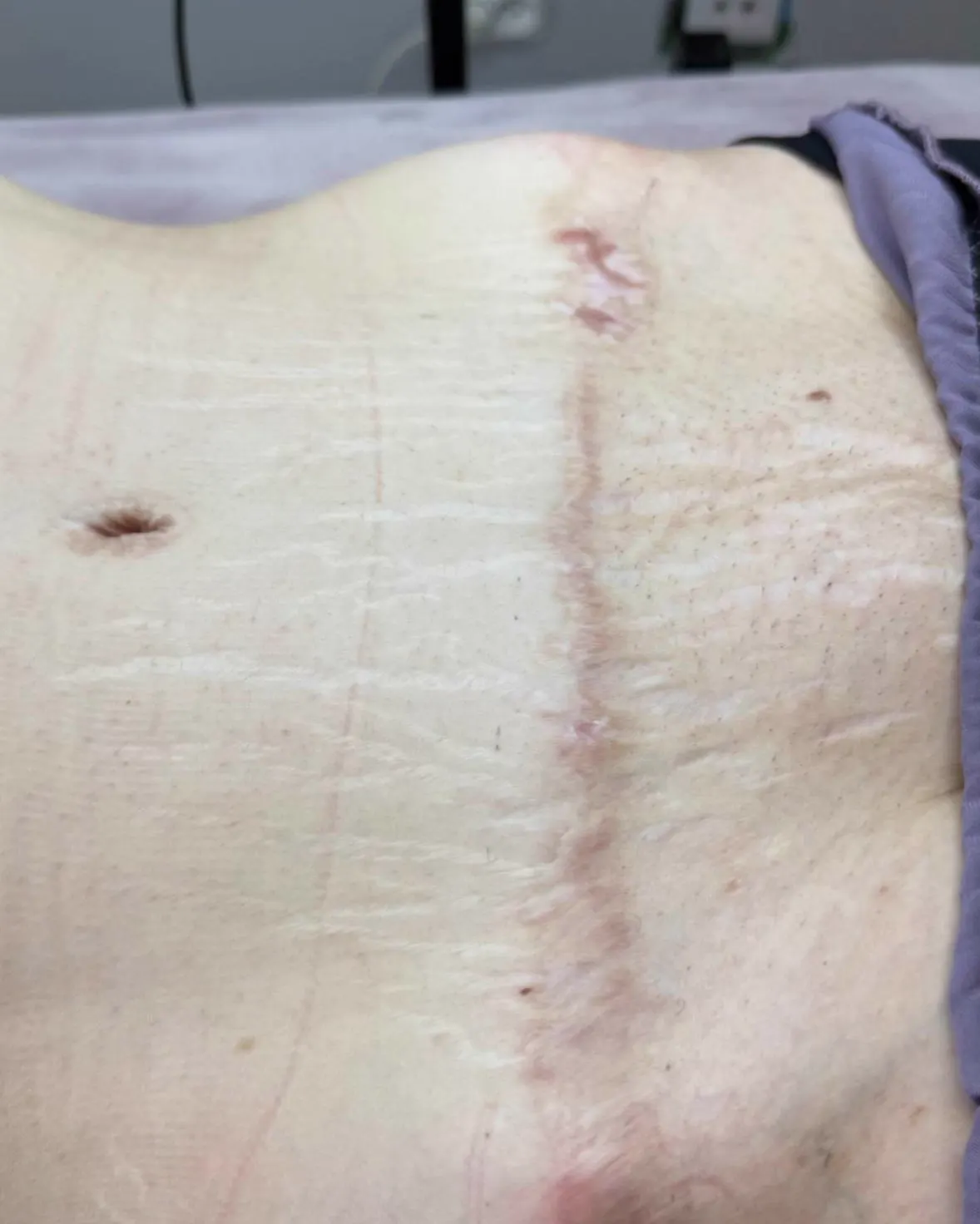 Healed abdominoplasty scar on a client before camouflage