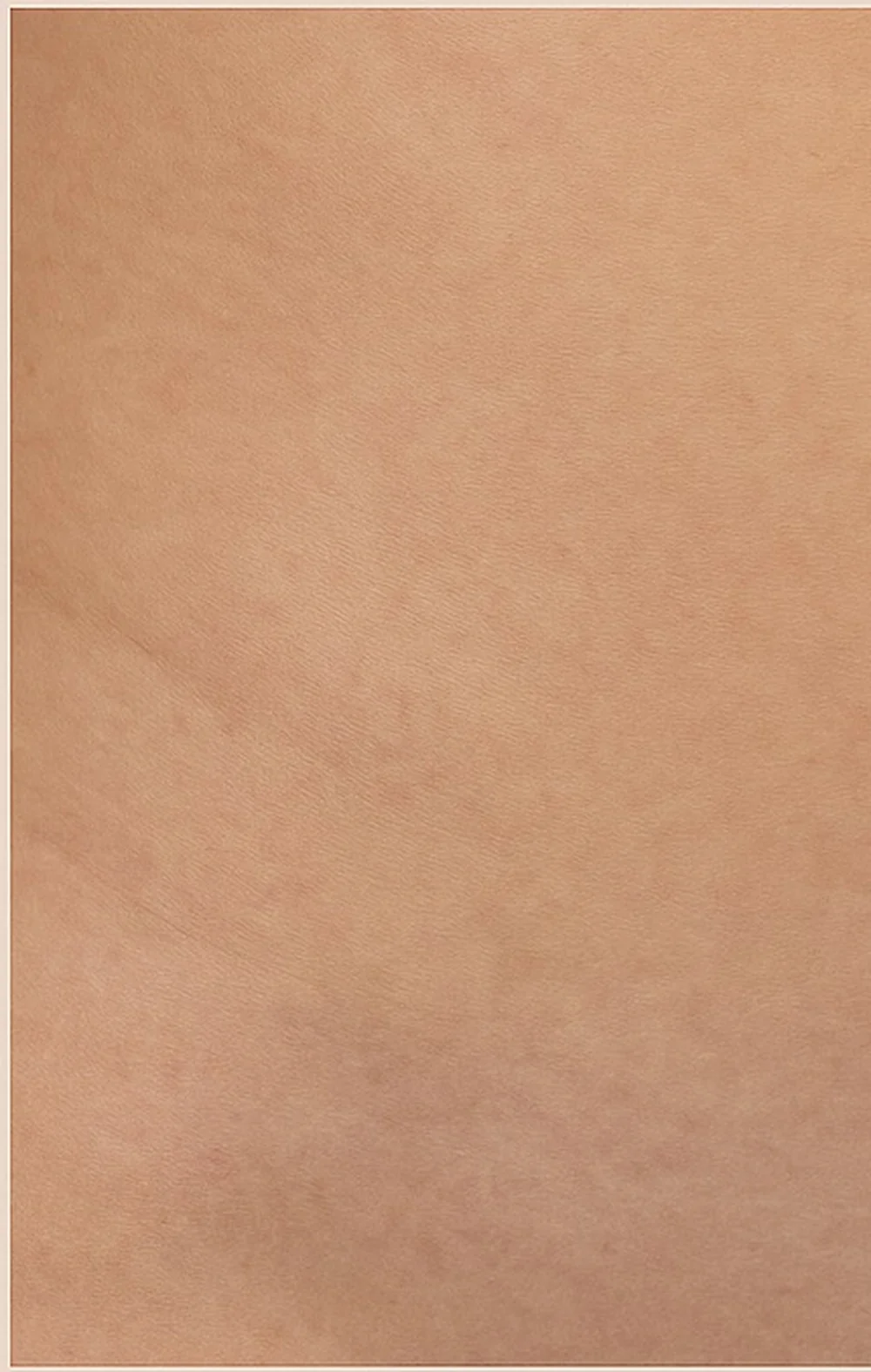 The same area after inkless revision, healed