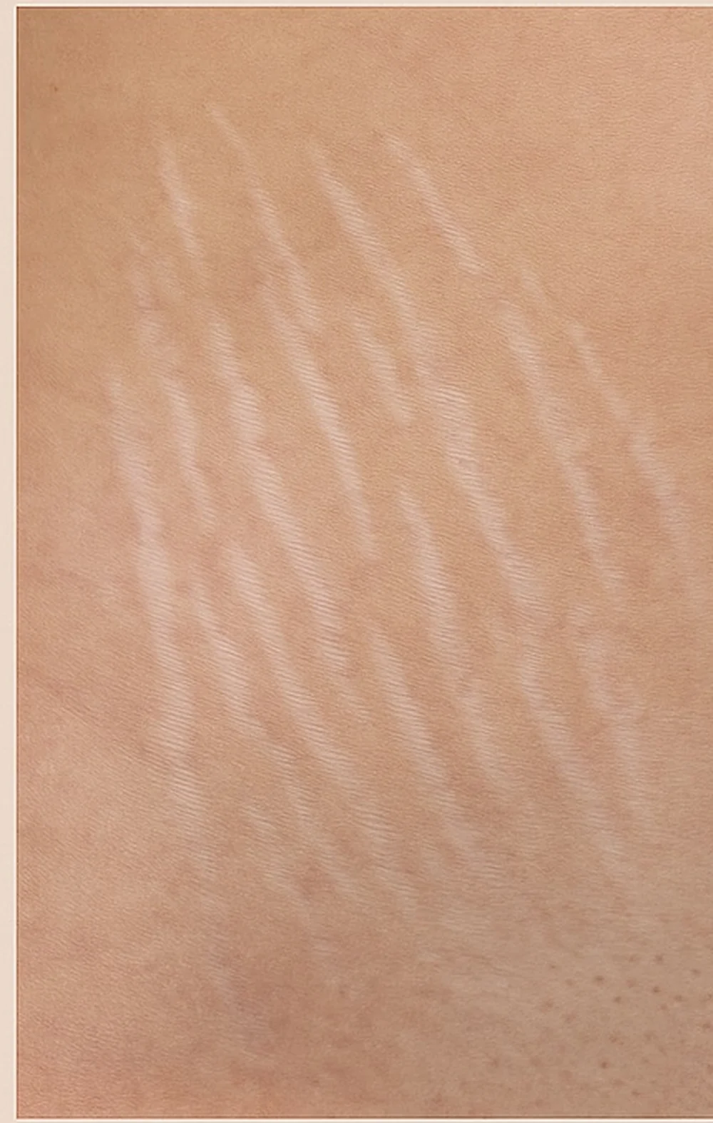 Stretch marks before inkless revision