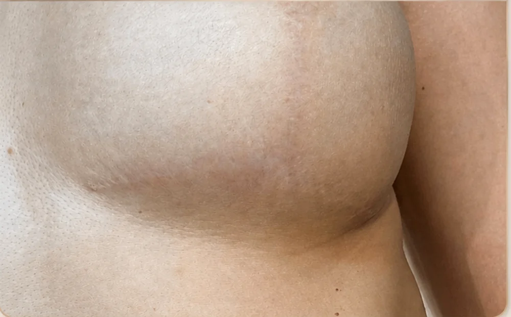 The same scar after camouflage, healed