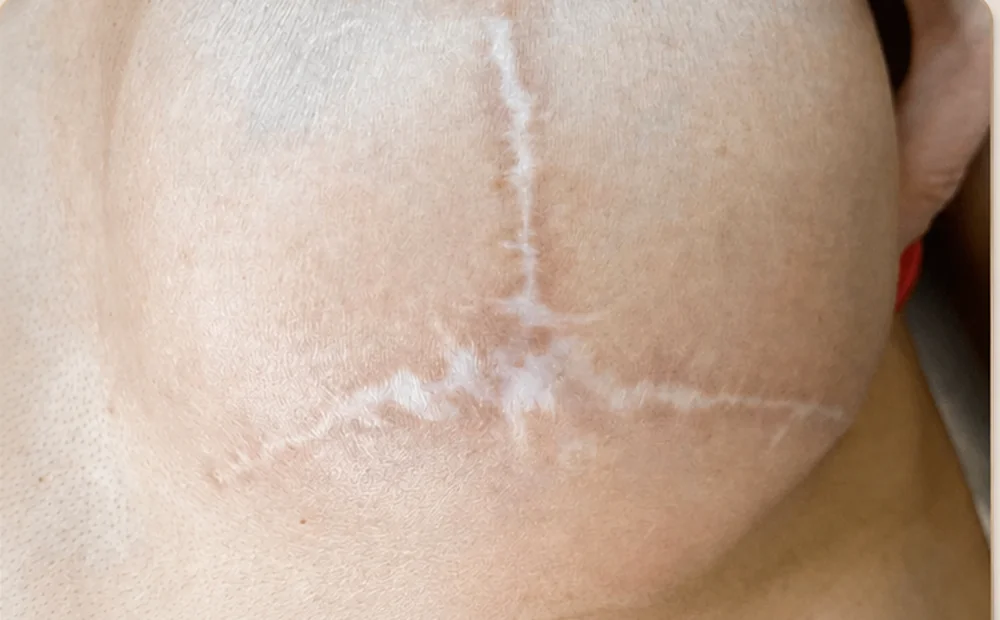 Breast surgery scar before camouflage